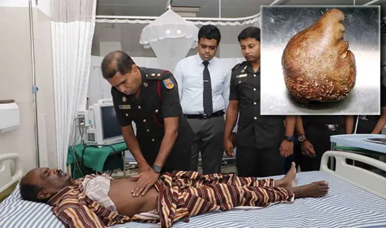 Sri Lanka'da Rekor Büyüklükte Mesane Taşı Çıkarıldı