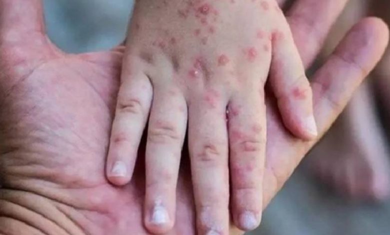 Güney Afrika'da son 5 haftada 13 m çiçeği vakası kaydedildi